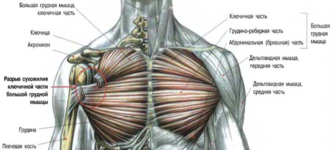 Разрыв большой грудной мышцы